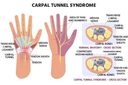 Dinkes Inhil Jelaskan Apa itu Carpal Tunnel Syndrome