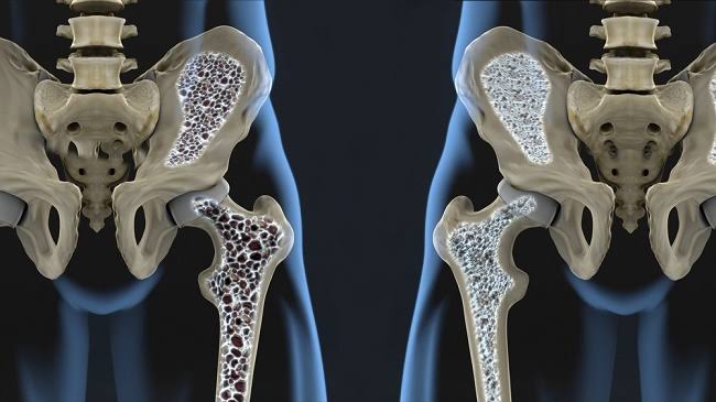 Mengenal Osteoporosis Melalui Penjelasan Dinkes Inhil